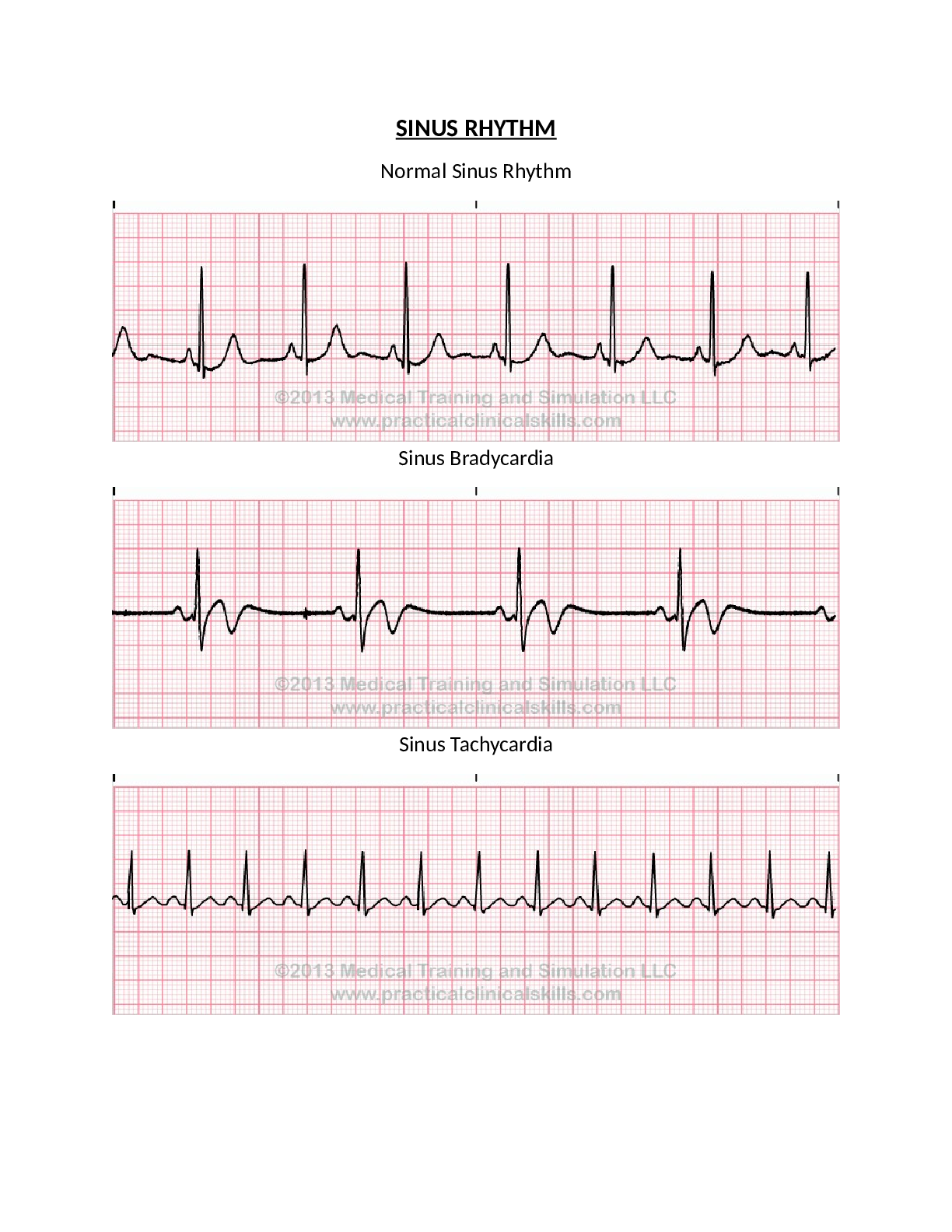 Preview of COMPLEX CR / NR 341 EKG strips (Chamberlain College of Nursing)