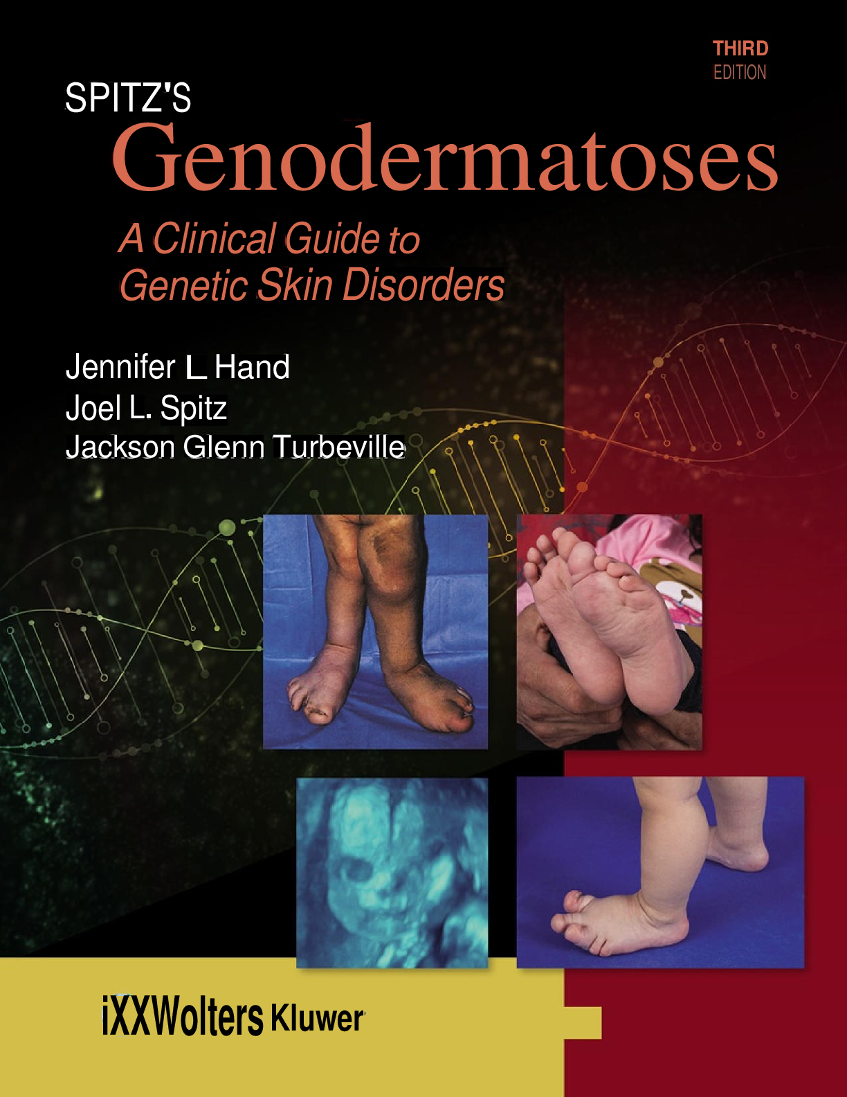 eBook PDF Genodermatoses Clinical Guide to Genetic Skin Disorders 3rd Edition By Jennifer L.Hand, Joel L. Spitz, Jackson GlennTurbeville