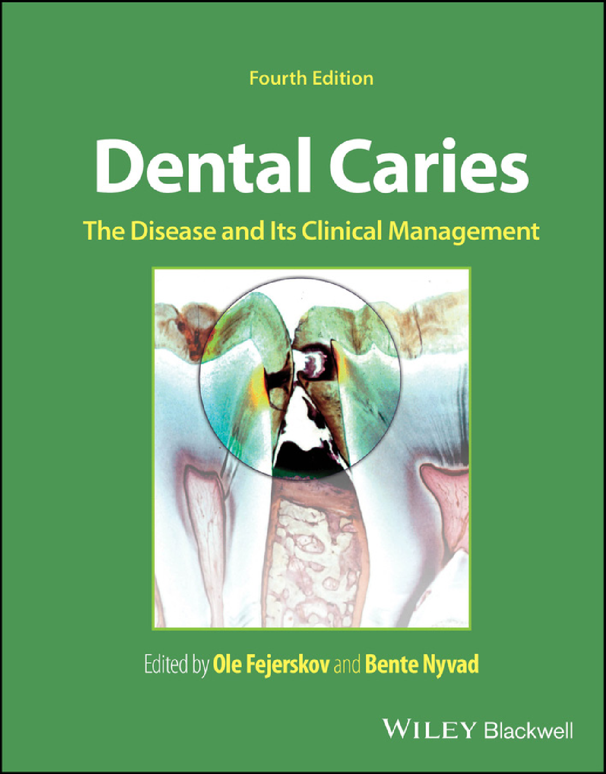Recommended document preview for eBook PDF Dental Caries The Disease and its Clinical Management 4th Edition By Ole Fejerskov, Bente Nyvad