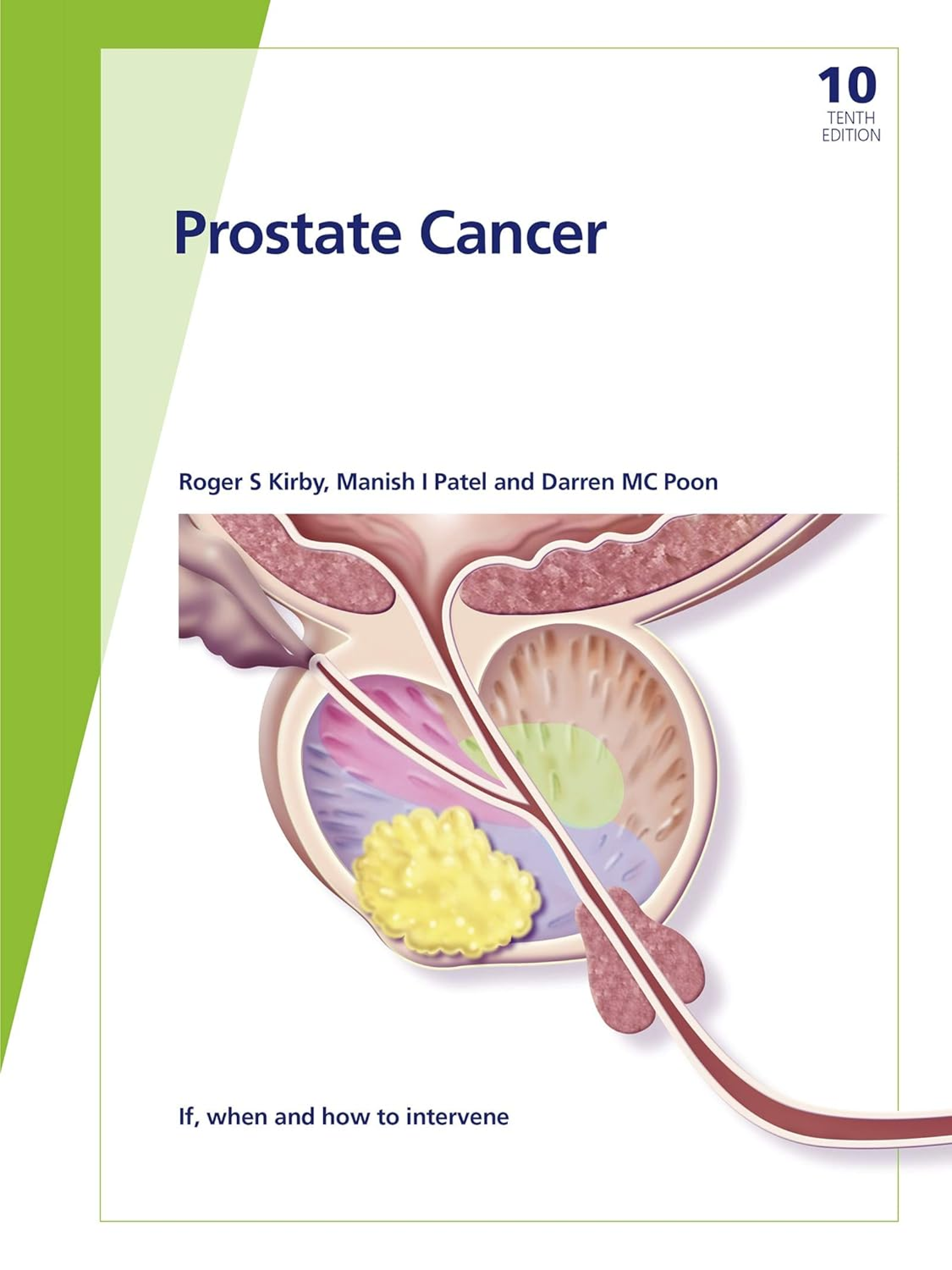 Recommended document preview for eBook PDF Fast Facts Prostate Cancer If when and how to intervene 10th Edition By R.S. Kirby, M.I. Patel, D.M.C. Poon