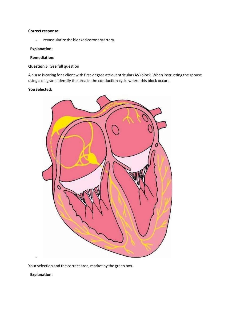 Preview page 2 of Passpoint Cardiovascular |  Which statement would lead the nurse to determine that a client lacks understand ng of her a