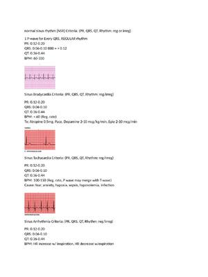 Preview of Relias Dysrhythmia rhythms | normal sinus rhythm (NSR) Criteria: (PR, QRS, QT, Rhythm: reg